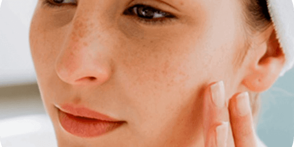 ¿Qué hacer si tengo dermatitis atópica?